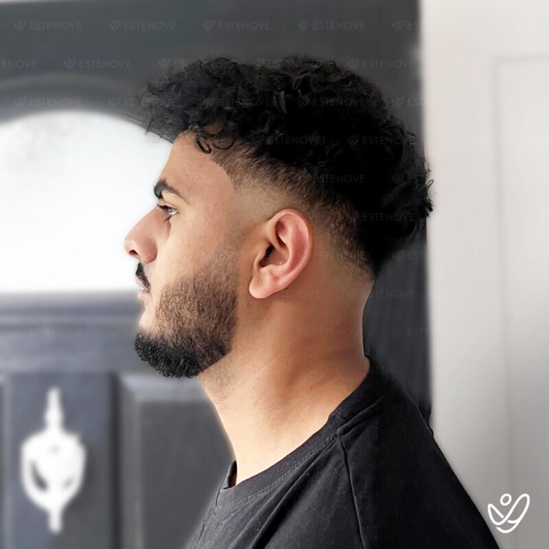 3200 Grafts Hair Transplant After Photo - Left Side 3200 Grafts Hair Transplant After Photo - Left Side