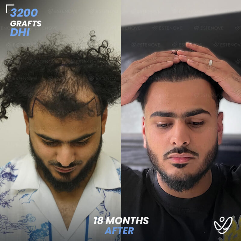 3200 Grafts Hair Transplant Before After - Hairline and Front 3200 Grafts Hair Transplant Before After - Hairline and Front