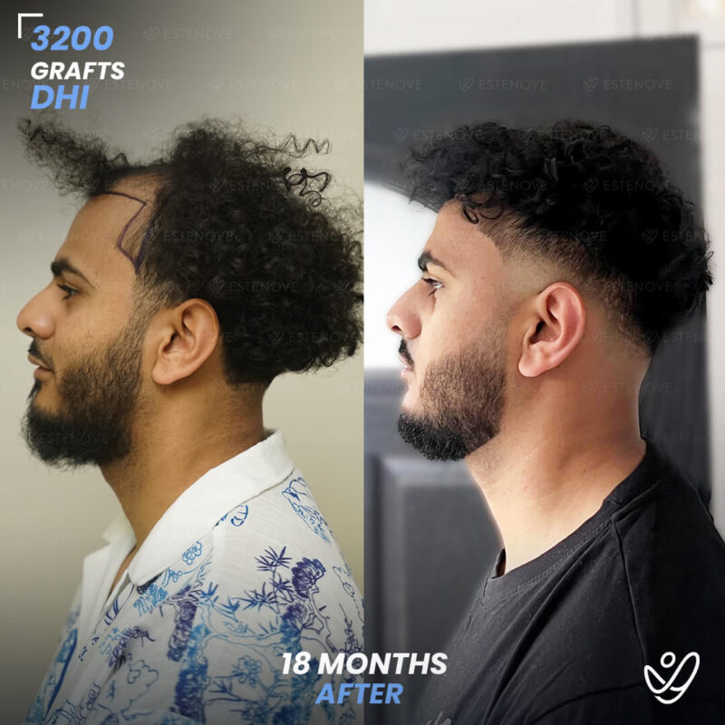 3200 Grafts Hair Transplant Before After - Left Side 3200 Grafts Hair Transplant Before After - Left Side