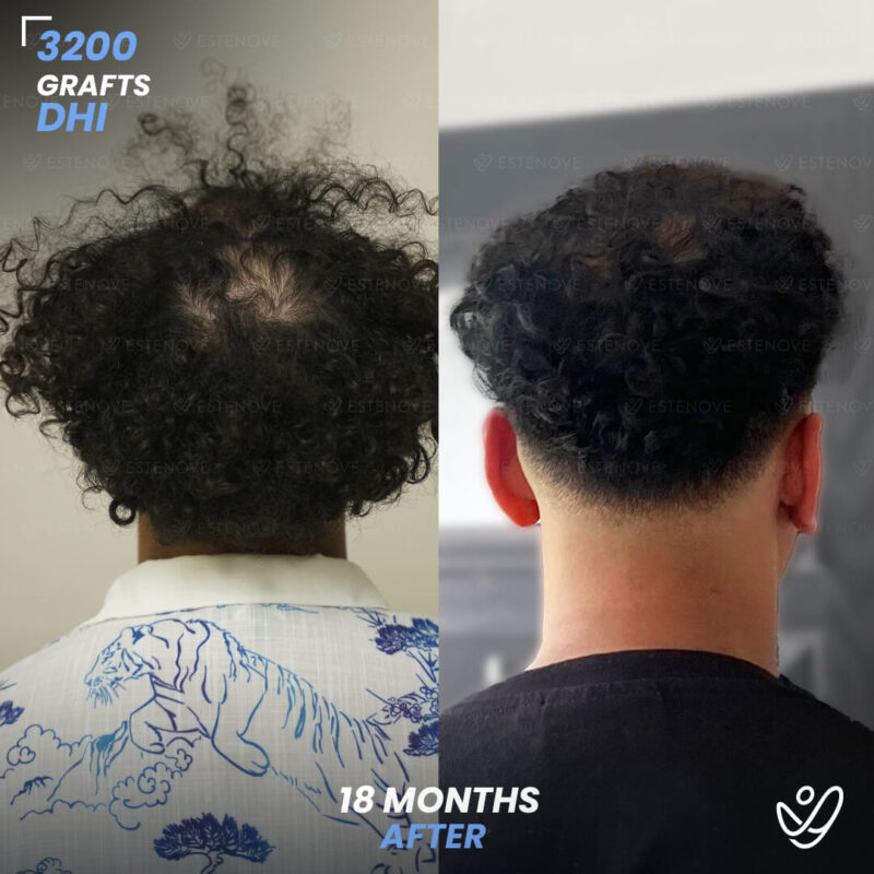 3200 Grafts Hair Transplant Before After - Crown 3200 Grafts Hair Transplant Before After - Crown