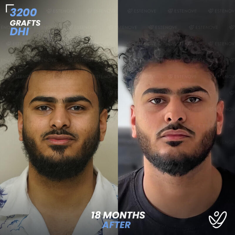 3200 Grafts Hair Transplant Before After 3200 Grafts Hair Transplant Before After