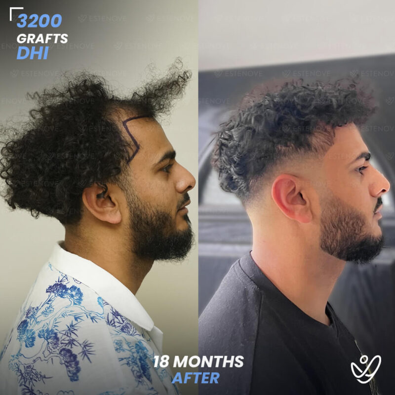 3200 Grafts Hair Transplant Before After - Right Side 3200 Grafts Hair Transplant Before After - Right Side