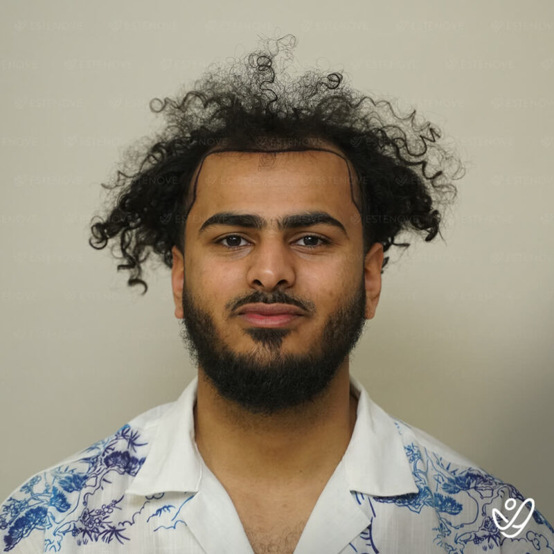 3200 Grafts Hair Transplant Before Photo 3200 Grafts Hair Transplant Before Photo