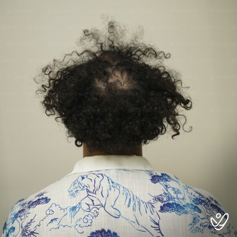 3200 Grafts Hair Transplant Before Photo - Behind 3200 Grafts Hair Transplant Before Photo - Behind