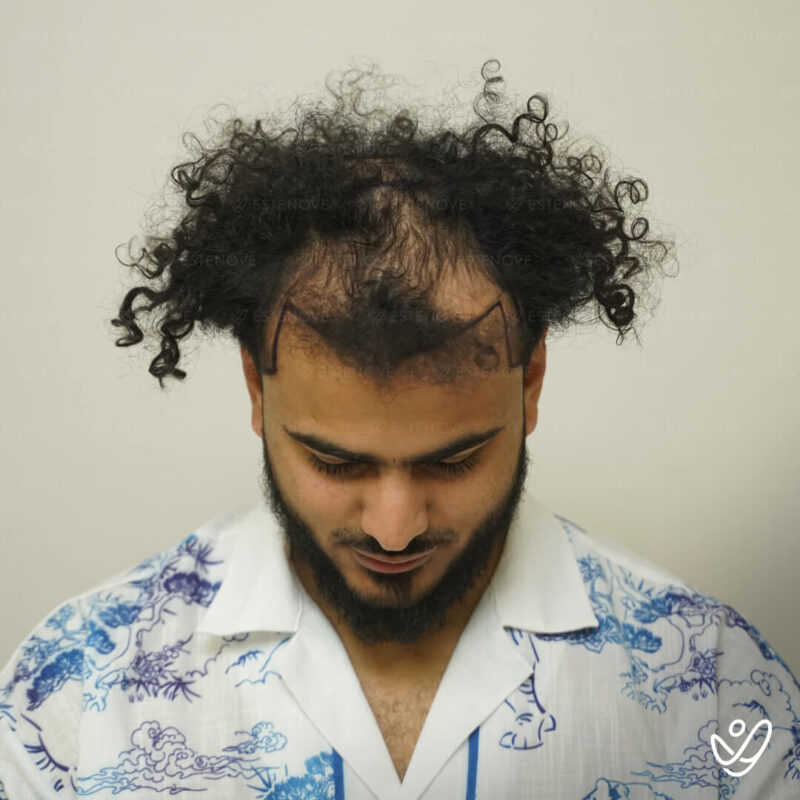 3200 Grafts Hair Transplant Before Photo - Crown 3200 Grafts Hair Transplant Before Photo - Crown