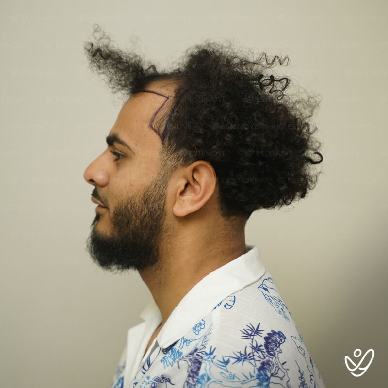 3200 Grafts Hair Transplant Before Photo - Side 3200 Grafts Hair Transplant Before Photo - Side