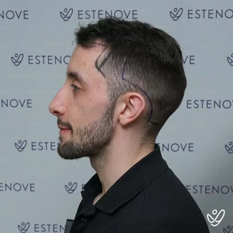 4 before hair transplant left side