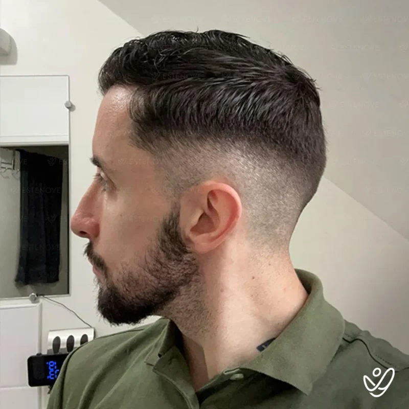 5 after hair transplant left side