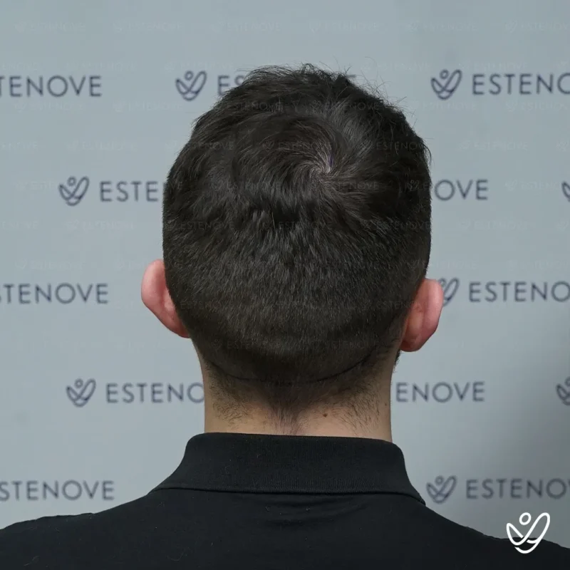 8 before hair transplant back side
