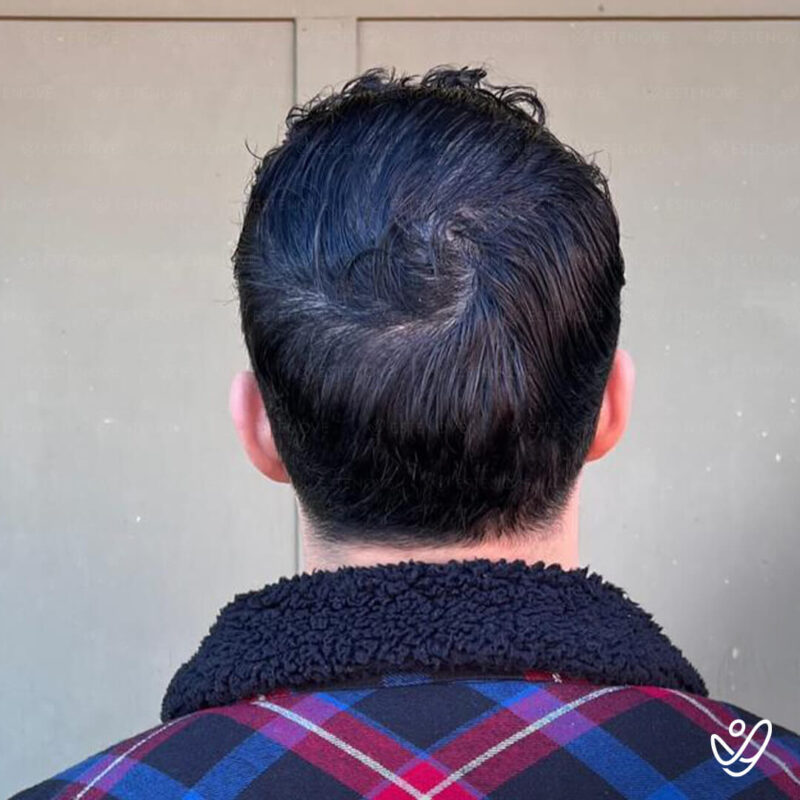 After Hair Transplant Photo (4500 grafts FUE) After Hair Transplant Photo (4500 grafts FUE)