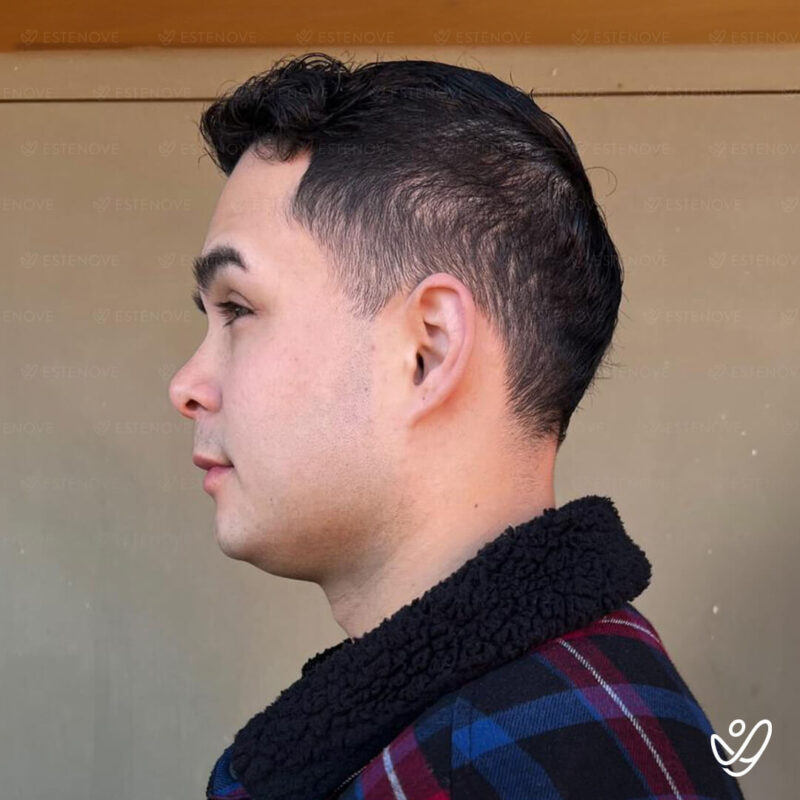 After Hair Transplant Photo (4500 grafts FUE) After Hair Transplant Photo (4500 grafts FUE)