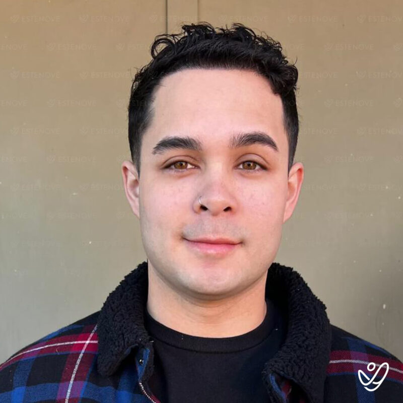 After Hair Transplant Photo (4500 grafts FUE) After Hair Transplant Photo (4500 grafts FUE)