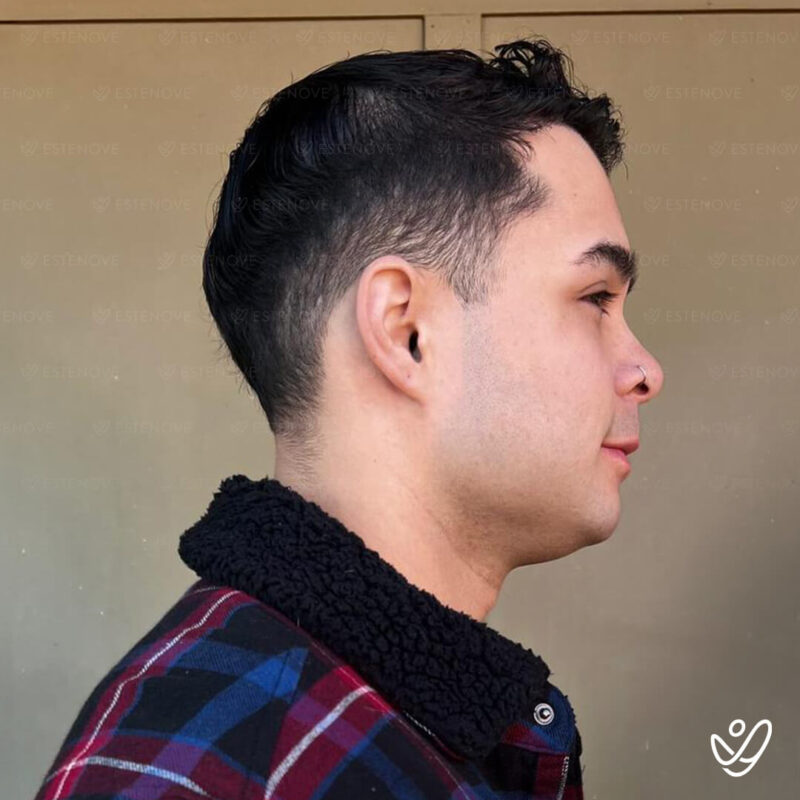 After Hair Transplant Photo (4500 grafts FUE) After Hair Transplant Photo (4500 grafts FUE)