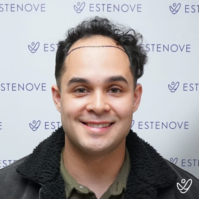 FUE 4500 Grafts Before Hair Transplant Photo FUE 4500 Grafts Before Hair Transplant Photo