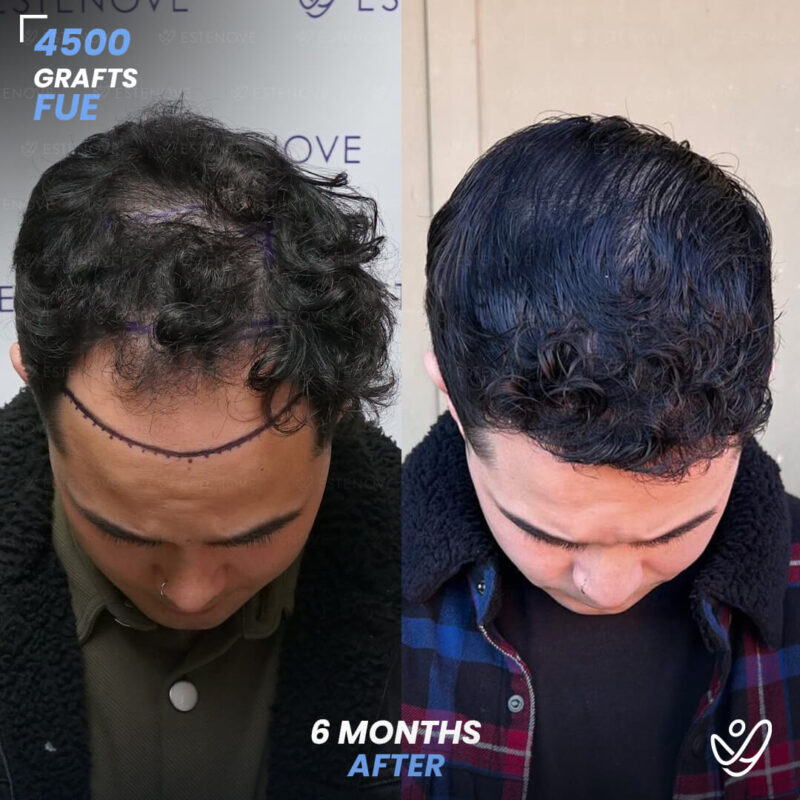 FUE 4500 Graft Hair Transplant 6 Months Before After FUE 4500 Graft Hair Transplant 6 Months Before After