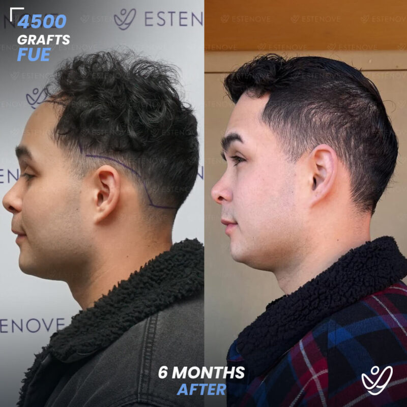 FUE 4500 Graft Hair Transplant 6 Months Before After FUE 4500 Graft Hair Transplant 6 Months Before After