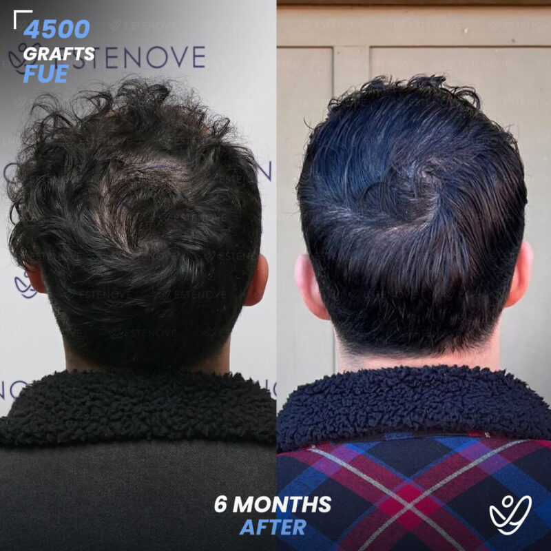 FUE 4500 Graft Hair Transplant 6 Months Before After FUE 4500 Graft Hair Transplant 6 Months Before After