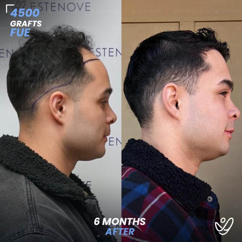 FUE 4500 Graft Hair Transplant 6 Months Before After FUE 4500 Graft Hair Transplant 6 Months Before After