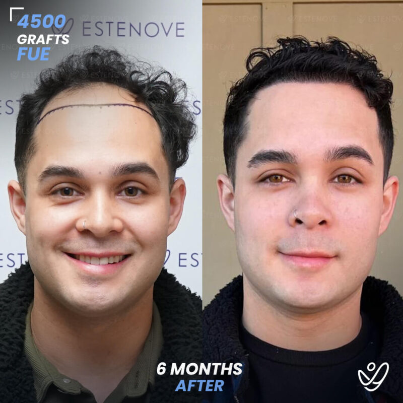 FUE 4500 Graft Hair Transplant 6 Months Before After FUE 4500 Graft Hair Transplant 6 Months Before After