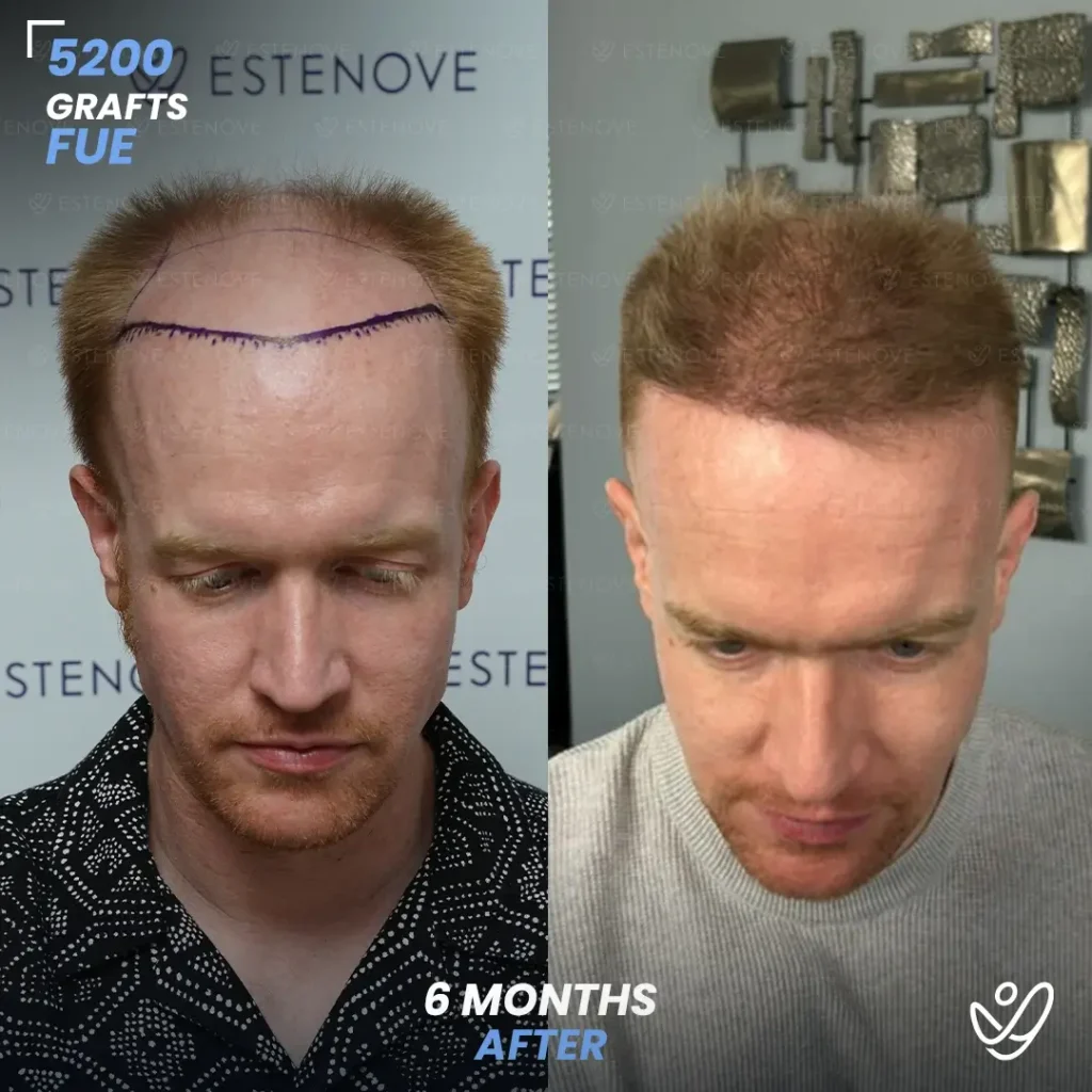 fue hair transplant after