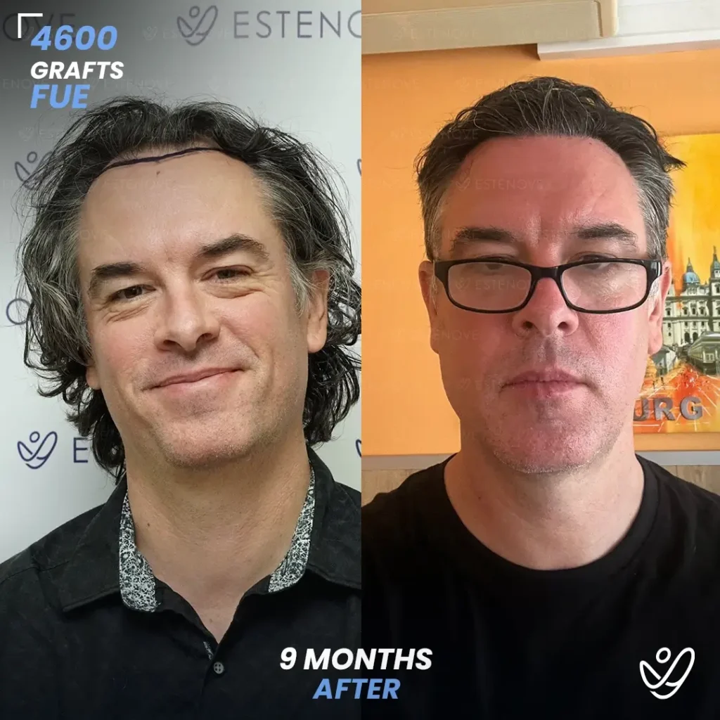 FUE 4600 Grafts Hair Transplant 9 Months Before&After
