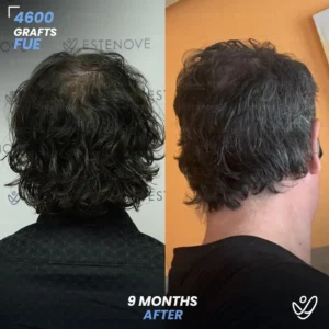 FUE 4600 Graft Hair Transplant Before After- Crown