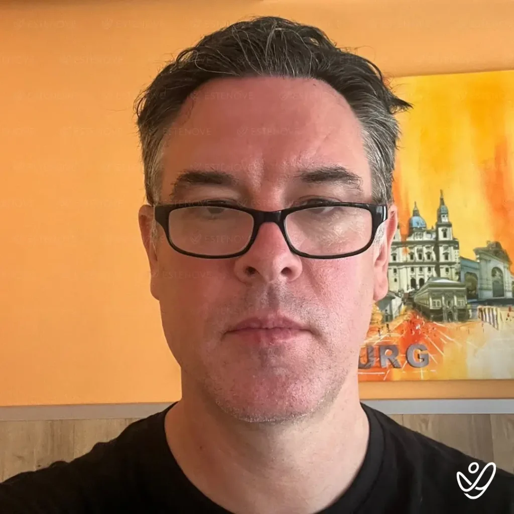 Mark_Pollard after hair transplantation from front