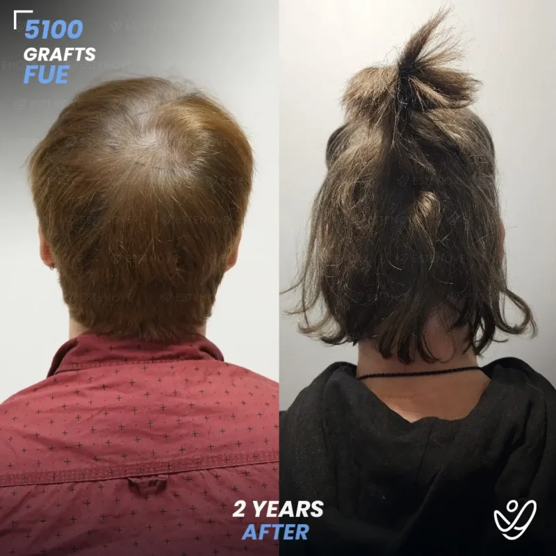 Benjamin-Newall4 FUE 5100 Graft Hair Transplant Before After- Crown