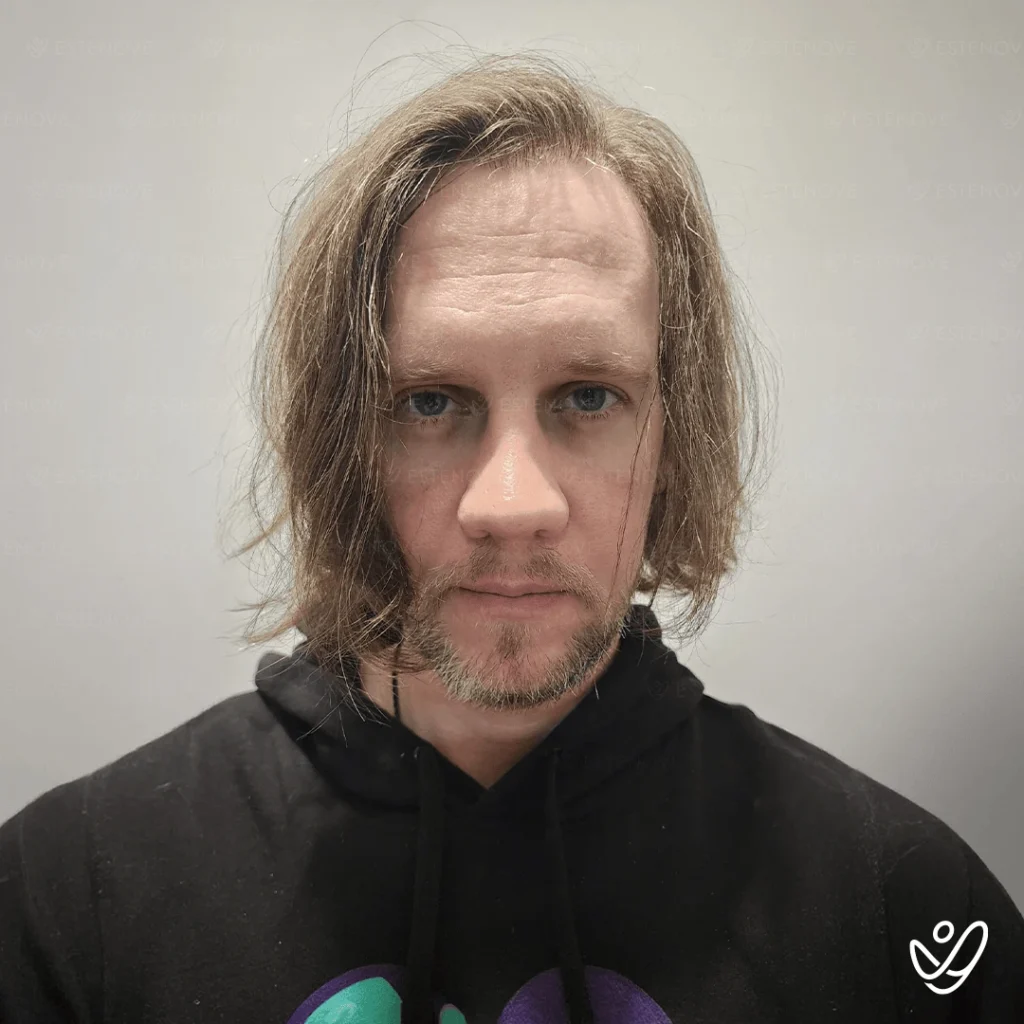 FUE 5100 Graft Hair Transplant Before After- Front