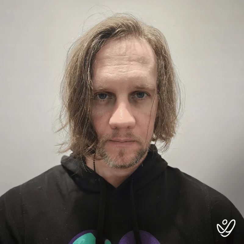 Benjamin-Newall7 FUE 5100 Graft Hair Transplant Before After- Front