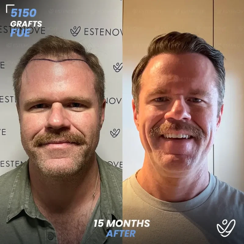 Matthew-Scholl1 FUE 5150 Graft Hair Transplant Before After- Front