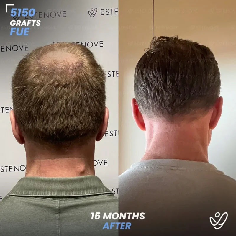 Matthew-Scholl5 FUE 5150 Graft Hair Transplant Before After- Crown