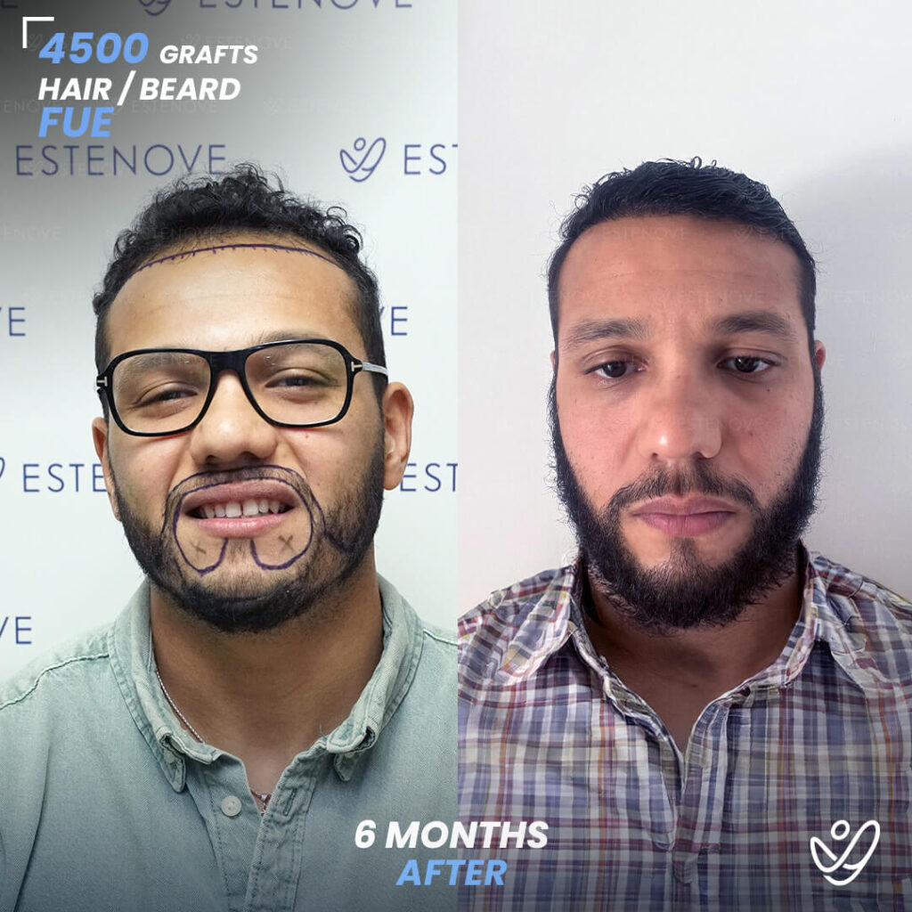 Beard transplant - 4500 grafts - 6 months before after Beard transplant - 4500 grafts - 6 months before after