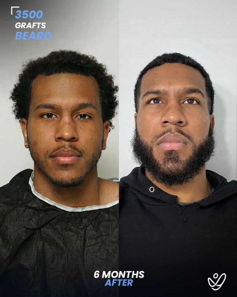 İNGİLİZCE AFRO 1 (1) male beard 3500 grafts 6 months after