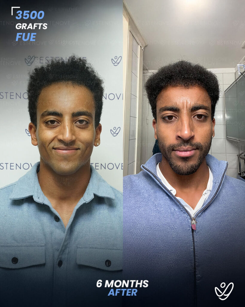 İNGİLİZCE AFRO 2 (1) male FUE 3500 grafts 6 months after