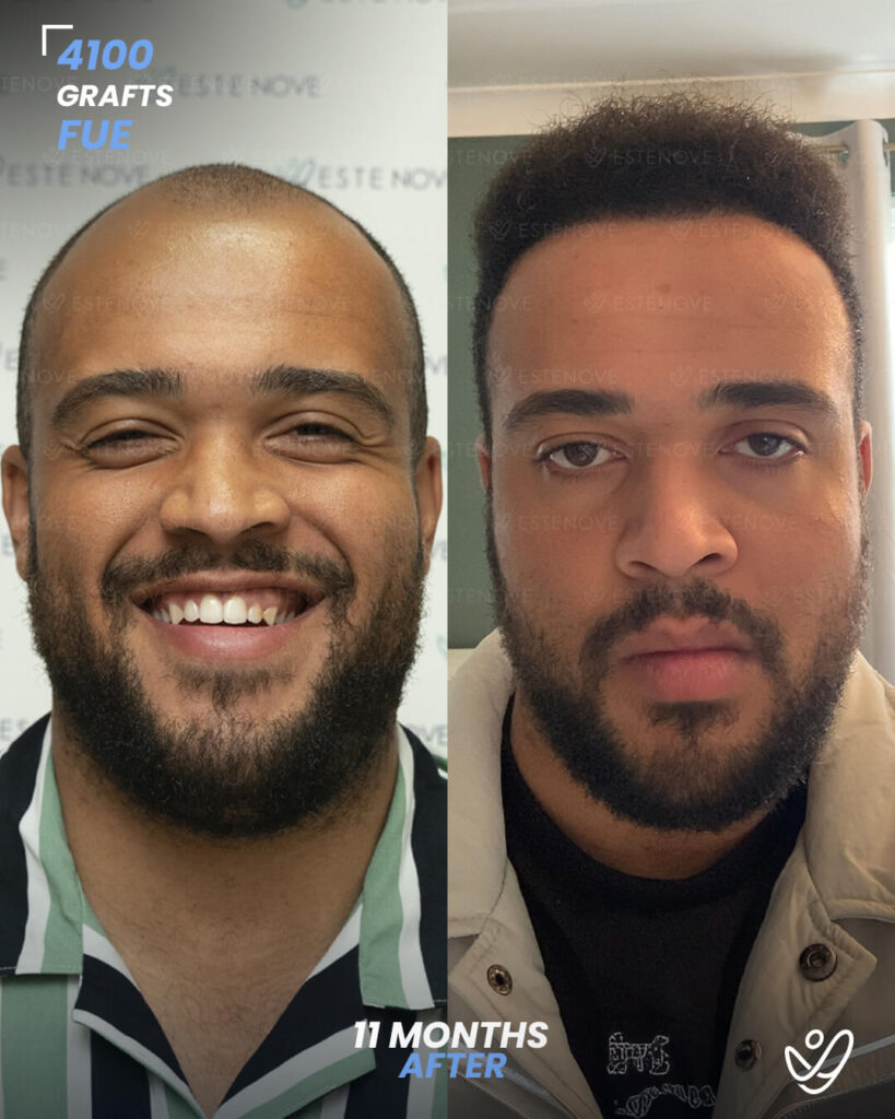 İNGİLİZCE AFRO 3 (1) male FUE 4100 grafts 11 months after