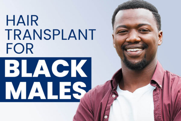 Hair Transplant for Black Males