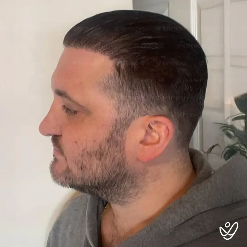Joey_Intrabartolo-13 (1) After hair transplant