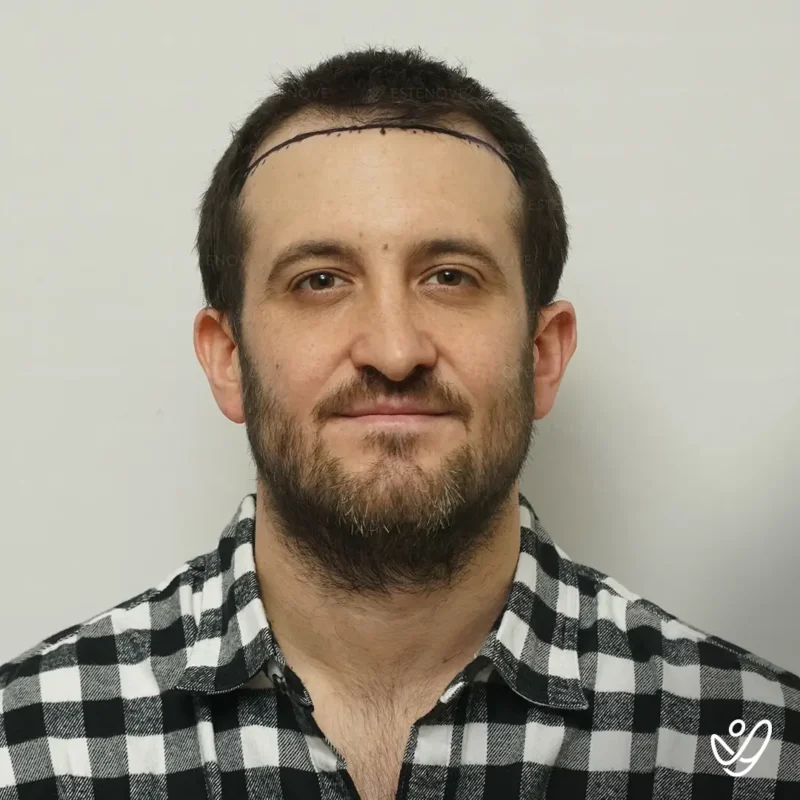 Joey_Intrabartolo-6 (1) before hair transplant process