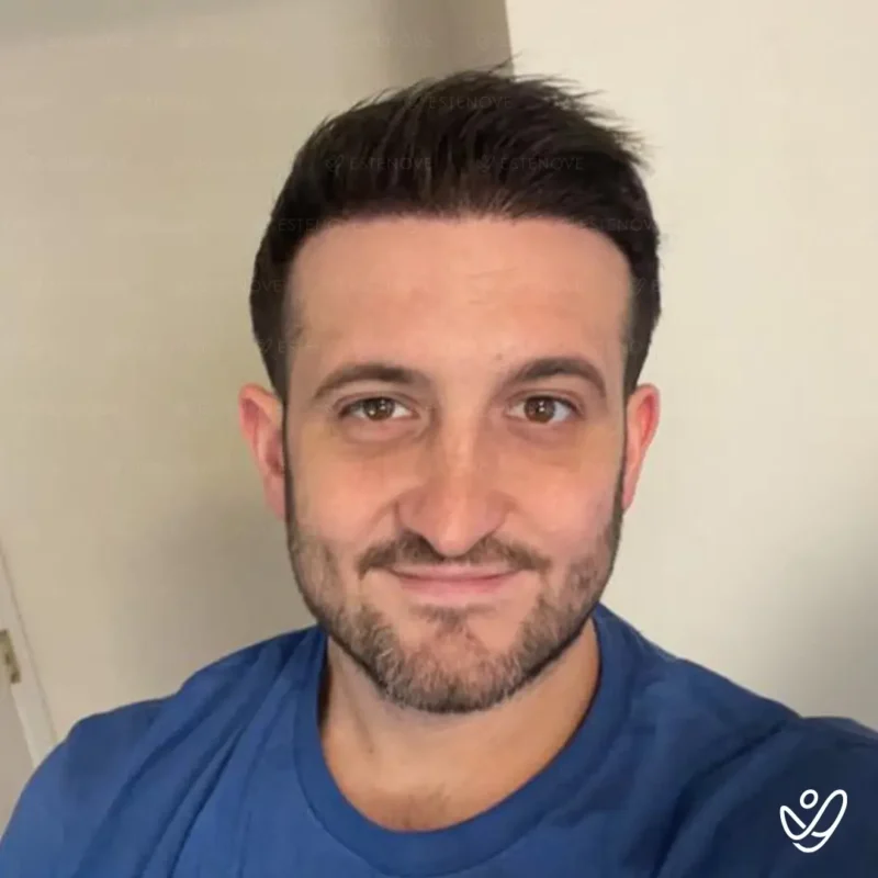 Joey_Intrabartolo-7 (1) After hair transplantation