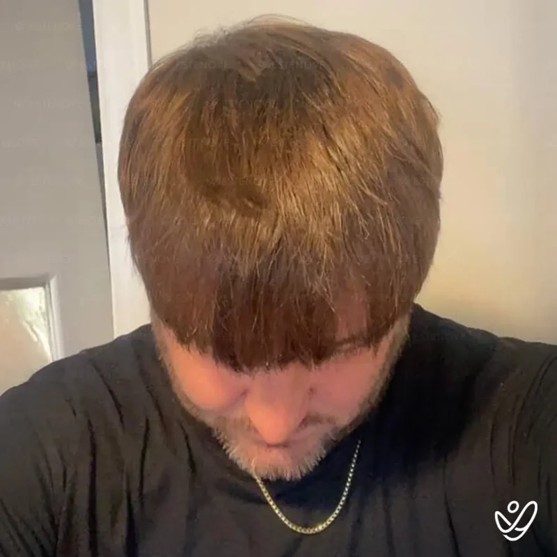 Joey_Intrabartolo-9B (1) After hair transplant process