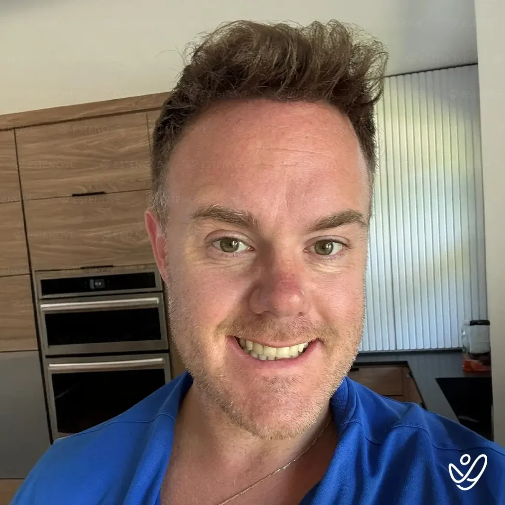 Men After a 5000 Grafts Hair Transplant