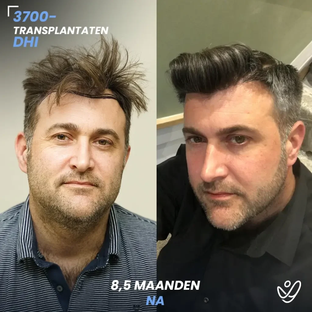 B_A-POST_Template_DU-B_A9 (1) 3700 Transplantaten DHI 8.5 Maaanden Na