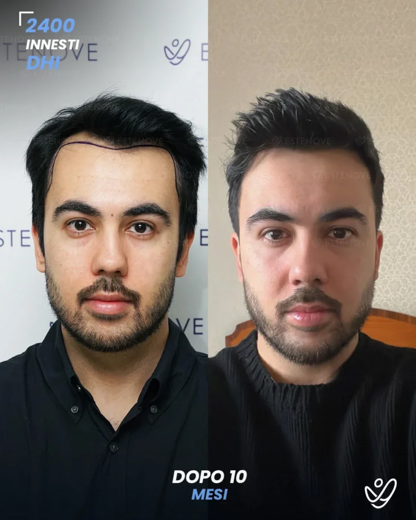 19 maschile DHI 2400 innesti 10 mesi prima e dopo