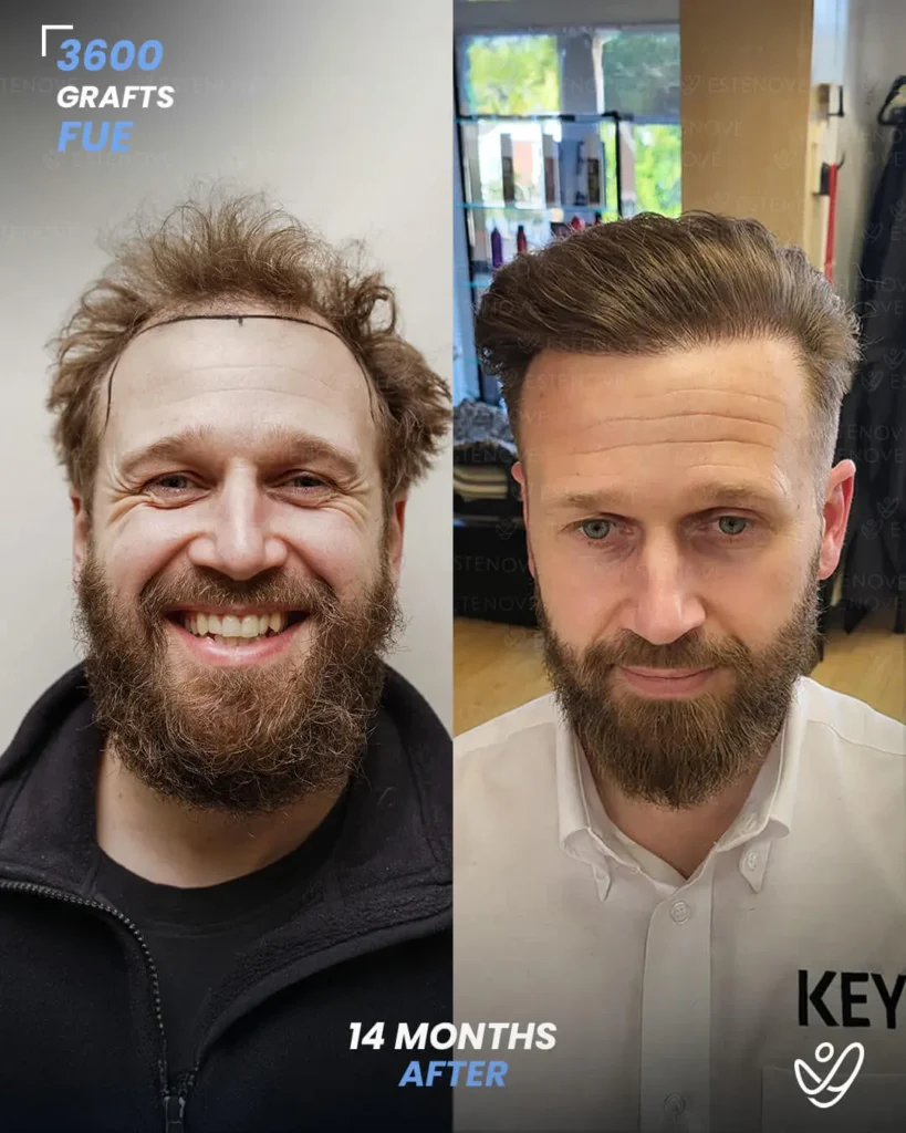FUE Hair Transplant 3600 Grafts 14 Months Before&After FUE Hair Transplant 3600 Grafts 14 Months Before&After