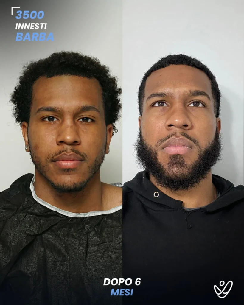 3 maschile barba 3500 innesti 6 mesi prima e dopo