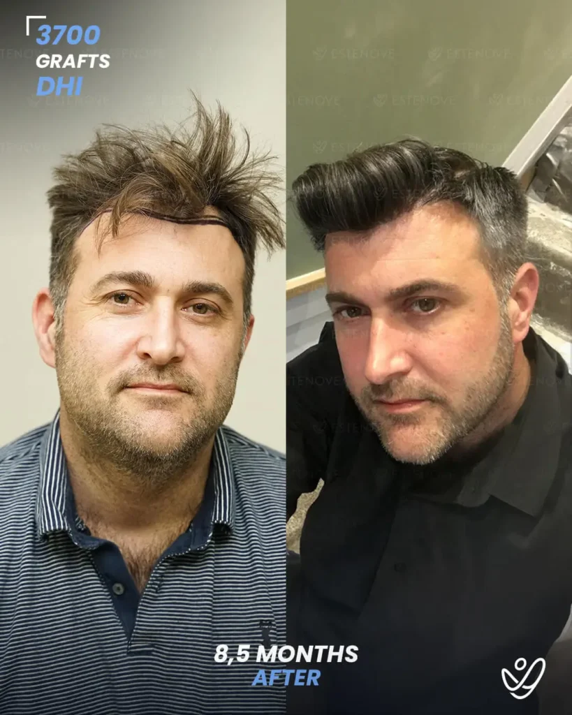 DHI Hair Transplant 3700 Grafts 8.5 Months Before&After DHI Hair Transplant 3700 Grafts 8.5 Months Before&After