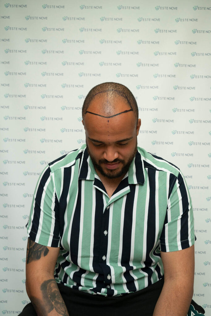Male Pattern Baldness