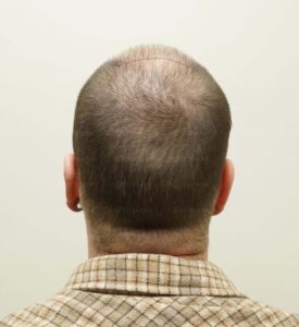 Back view showing visible scalp due to low follicle density per square inch.