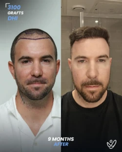 3100 graft before & 9 months after hair transplant, DHI 3100 graft before & 9 months after hair transplant, DHI